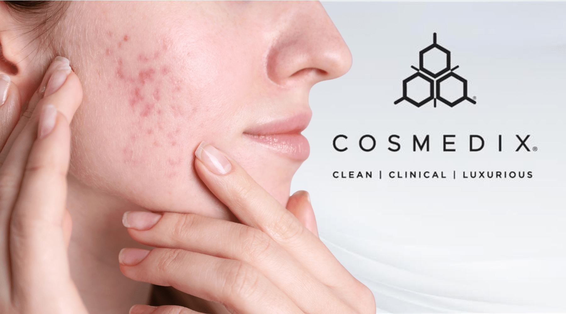 Adult Acne Without Irritation: A Barrier-First Treatment Plan - Cosmedix