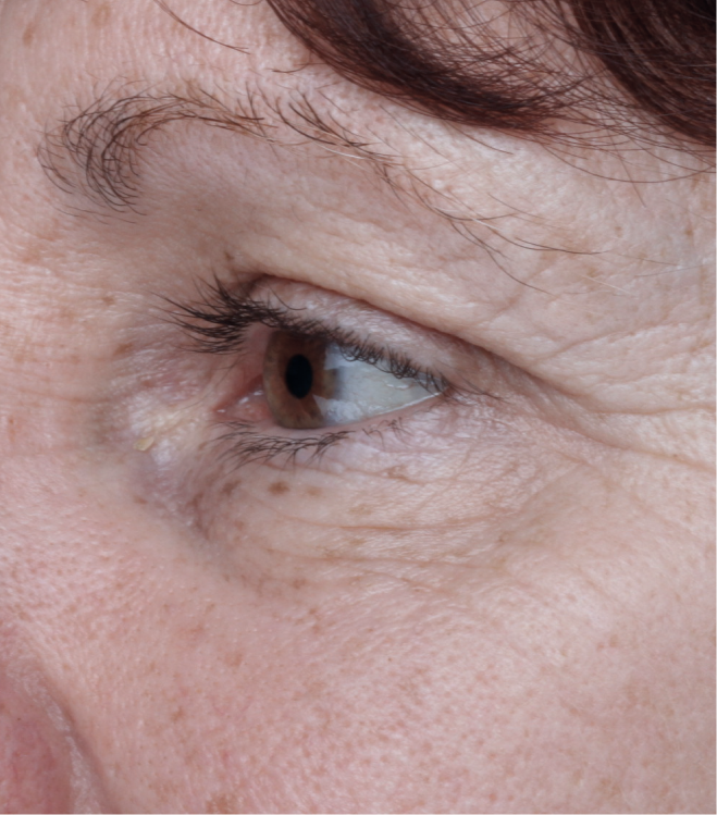 BEFORE_-_OPTI_CRYSTAL_-_square_8a619503-f383-48b3-99bc-88f111105647.png